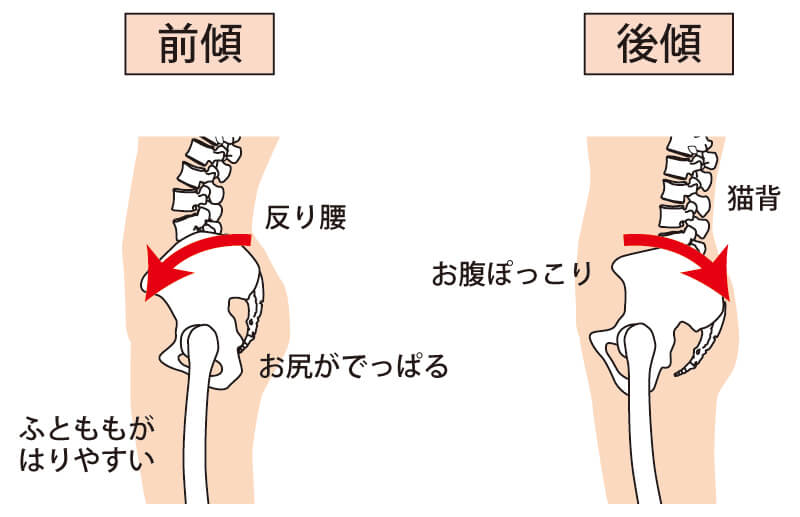 骨盤歪み